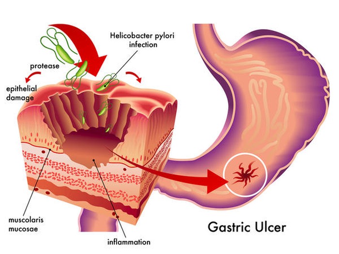 Gastrite e Helicobacter Pylori